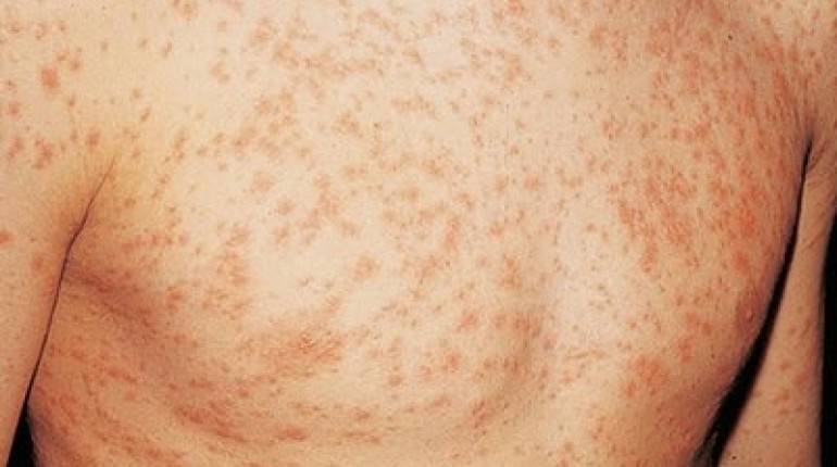 identifying skin rashes
