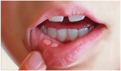 What Are Canker Sores? Why Do We Keep On Experiencing Those Painful Patches Inside Our Mouth?