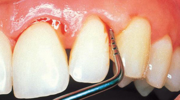 Here's The Thing About Periodontitis Treatment