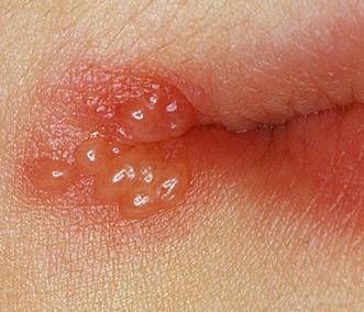 Herpes Simplex Virus - American Academy of Dermatology