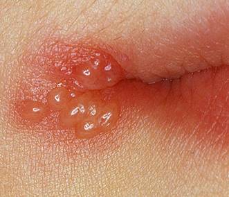 Cheilitis Pictures, Images & Photos | Photobucket