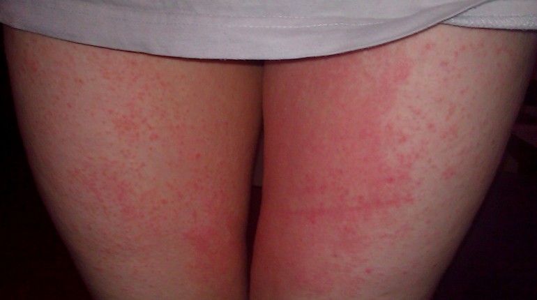 diabetic skin rashes pictures #11