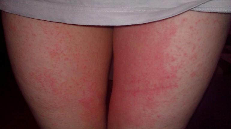 Causes of Hives in Adults | LIVESTRONG.COM