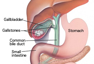 Things You Need To Know About Gallstone Surgery