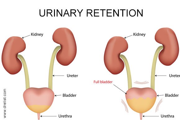 What Are The Symptoms That Indicate Urine Retention?
