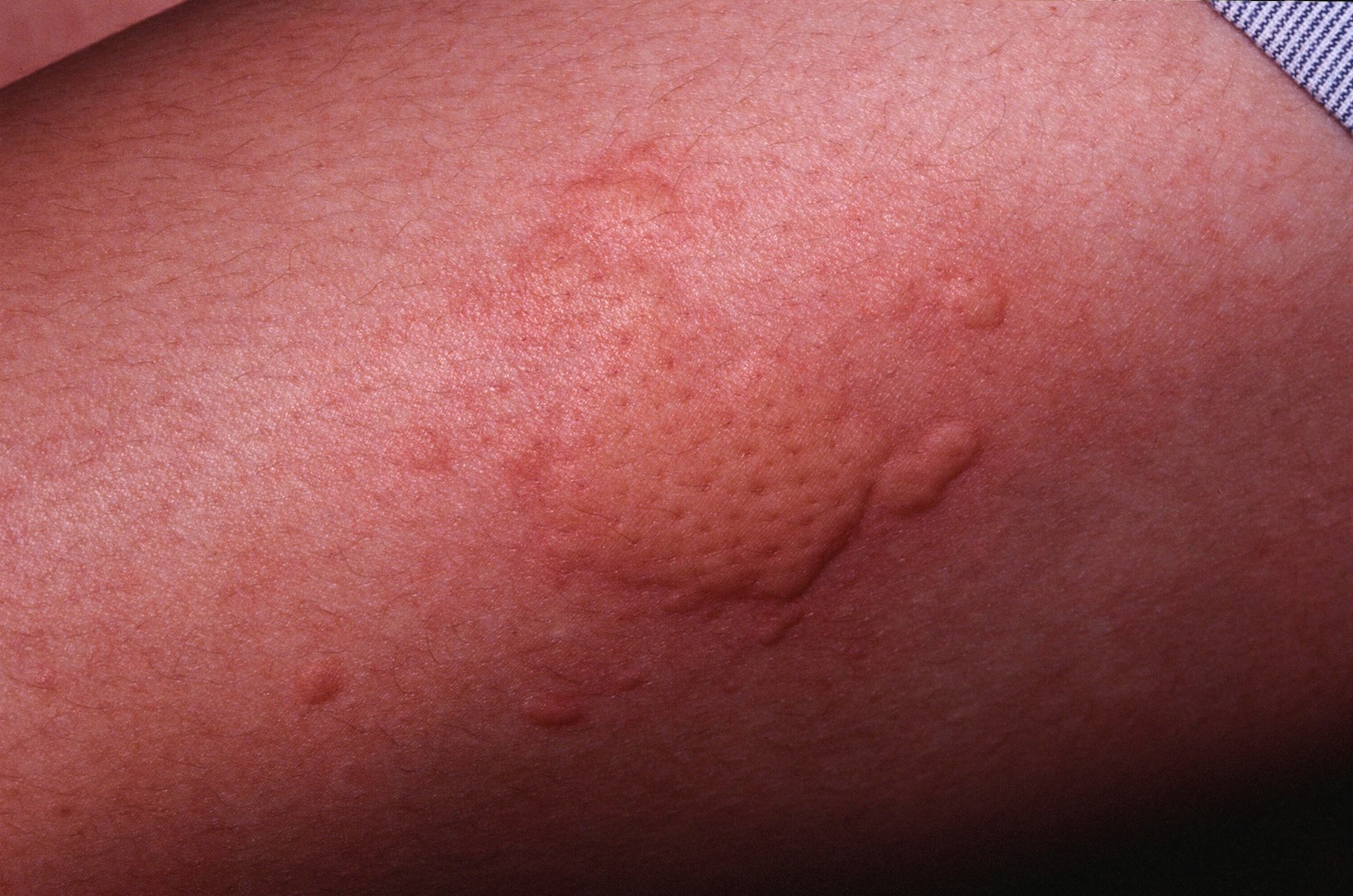 urticaria-hives-in-children-symptoms-rash-causes-treatment