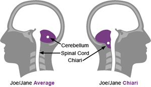 Things You Need To Know About Chiari Malformation Symptoms
