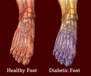 Is It Possible To Develop Diabetic Neuropathy If I Have Diabetes?