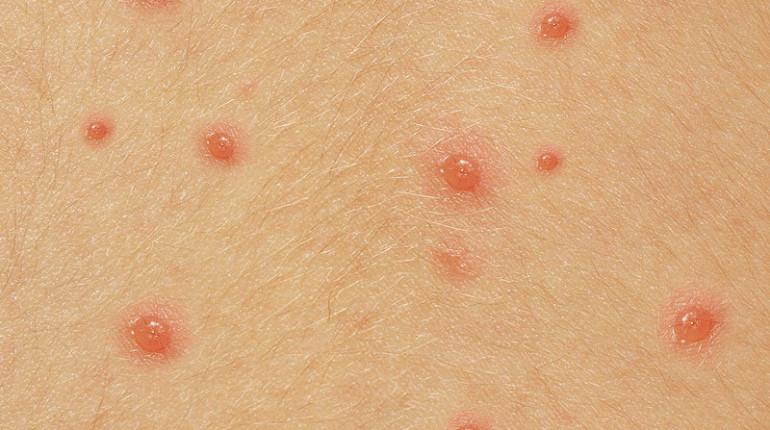 When does chicken pox become contagious?