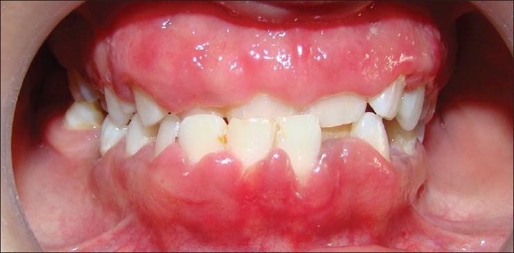 here-s-how-to-treat-swollen-gums-med-scoop-daily