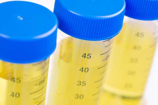 Things You Need To Know About Urine Osmolality Test