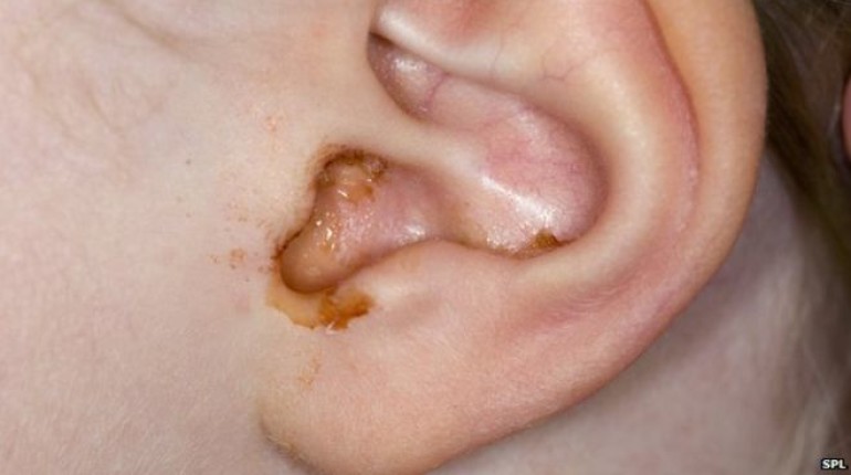 How To Deal With Earwax Buildup