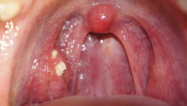 Bad Breath All The Time? Blame It To The Tonsil Stones