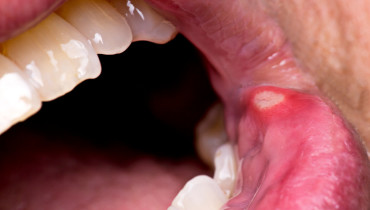 What Are Canker Sores? Why Do We Keep On Experiencing Those Painful Patches Inside Our Mouth?
