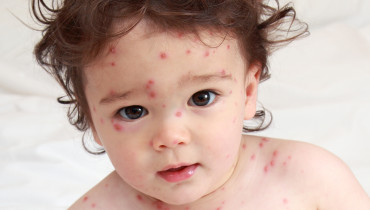 Can You Get Chicken Pox Twice?