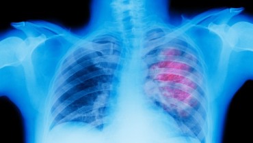 Cuba Has Launched A Promising Lung Cancer Vaccine