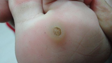 How Can We Eliminate Those Disgusting Plantar Warts?