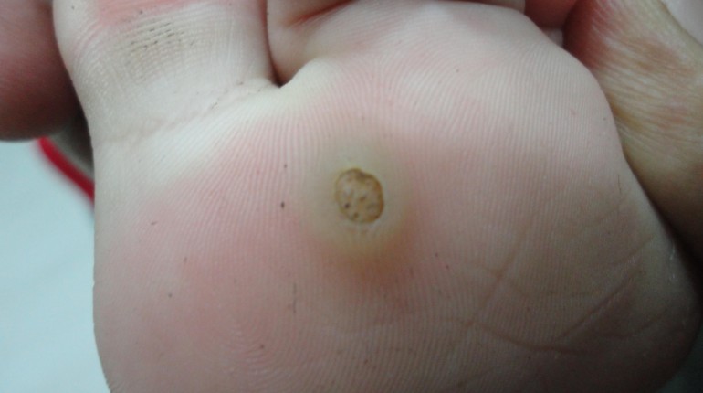 How Can We Eliminate Those Disgusting Plantar Warts?