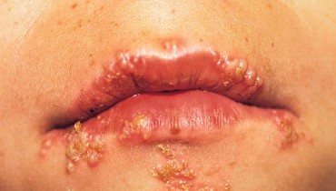 What Causes Herpes Labialis And How Can We Treat Them?