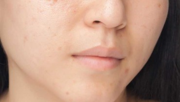How To Tame Chicken Pox Scars?