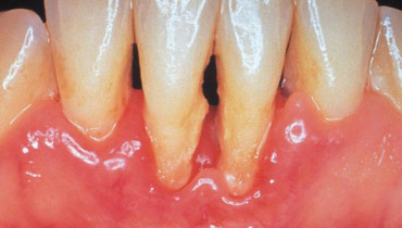 Here's The Thing About Periodontitis Treatment
