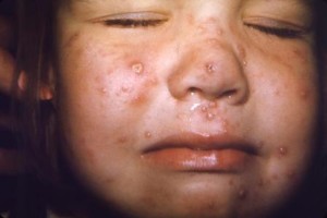 How To Tame Chicken Pox Scars? - Med Scoop Daily