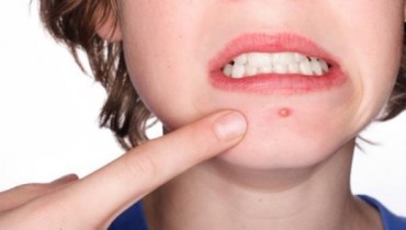 Why Stress Causes Acne Breakouts?