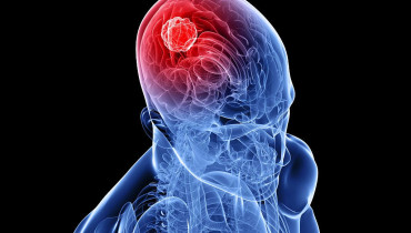 Facts On Brain Cancer Survival Rate