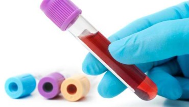 Understanding Herpes Blood Test
