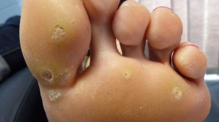 What Are Warts?