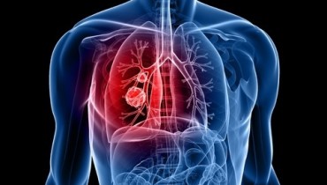 7 Warning Signs Of Lung Cancer