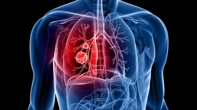 7 Warning Signs Of Lung Cancer