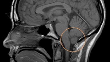 Things You Need To Know About Chiari Malformation Symptoms