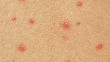 Is Chicken Pox Contagious?