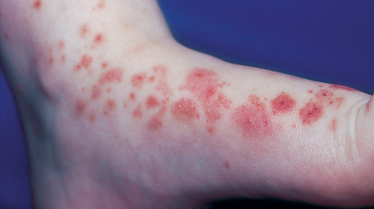 What Is Allergic Purpura And How Is It Treated?