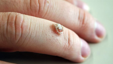 What Is The Best Way For Wart Removal?