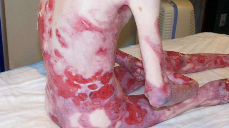 What You Must Know About Dystrophic Epidermolysis Bullosa