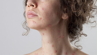 Why Chickenpox In Adults Is Worst Than In Children