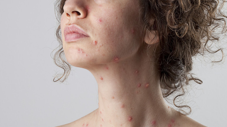 Why Chickenpox In Adults Is Worst Than In Children