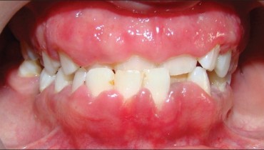 Here's How To Treat Swollen Gums