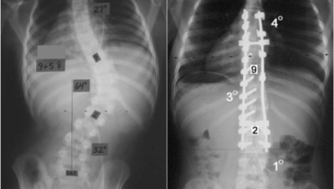 How Spinal Fusion And Discectomy Differ
